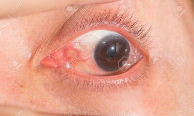 infeccion ocular