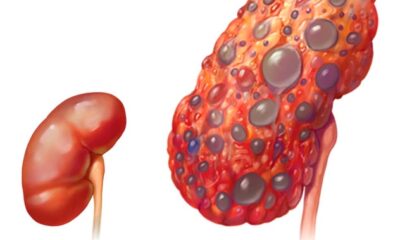 insuficiencia renal