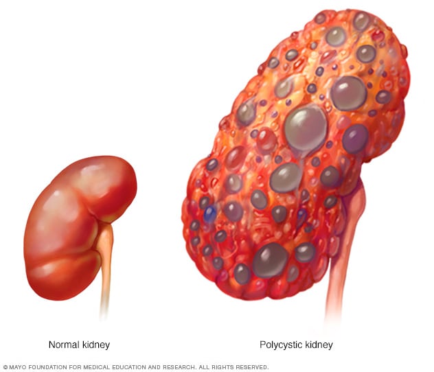 insuficiencia renal